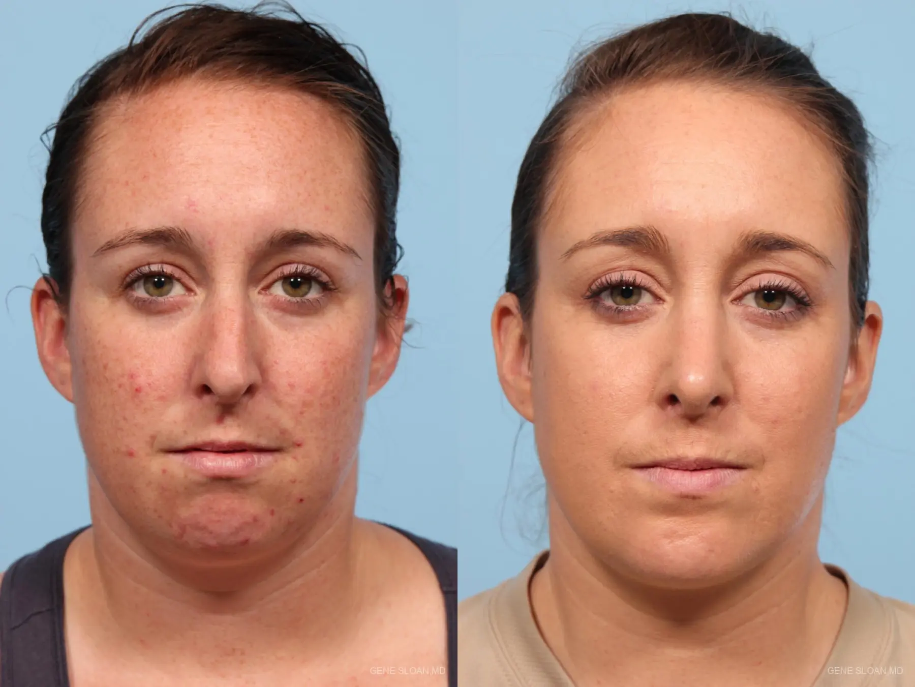 Rhinoplasty: Patient 4 - Before and After 1