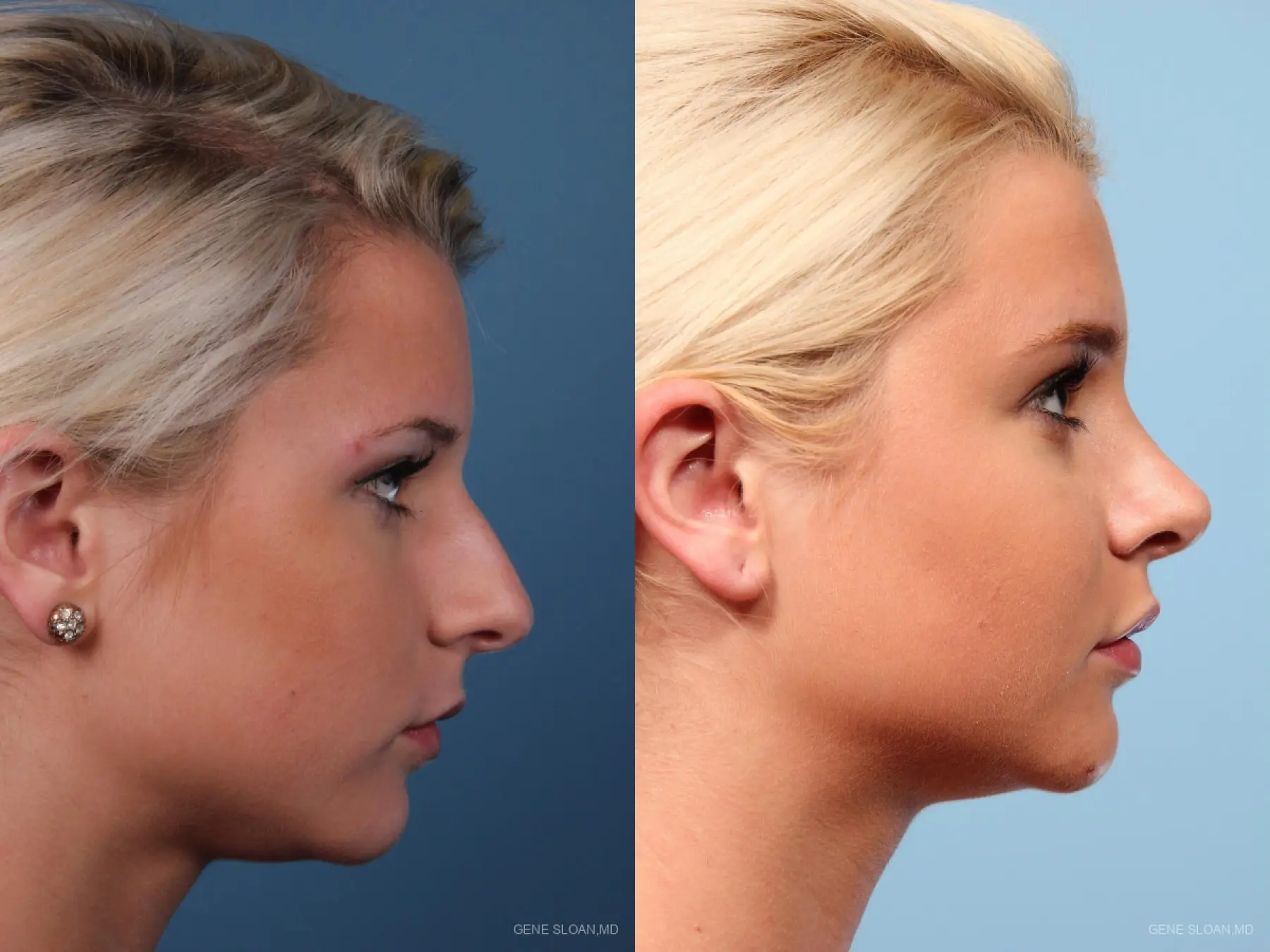 Rhinoplasty: Patient 8 - Before and After 2