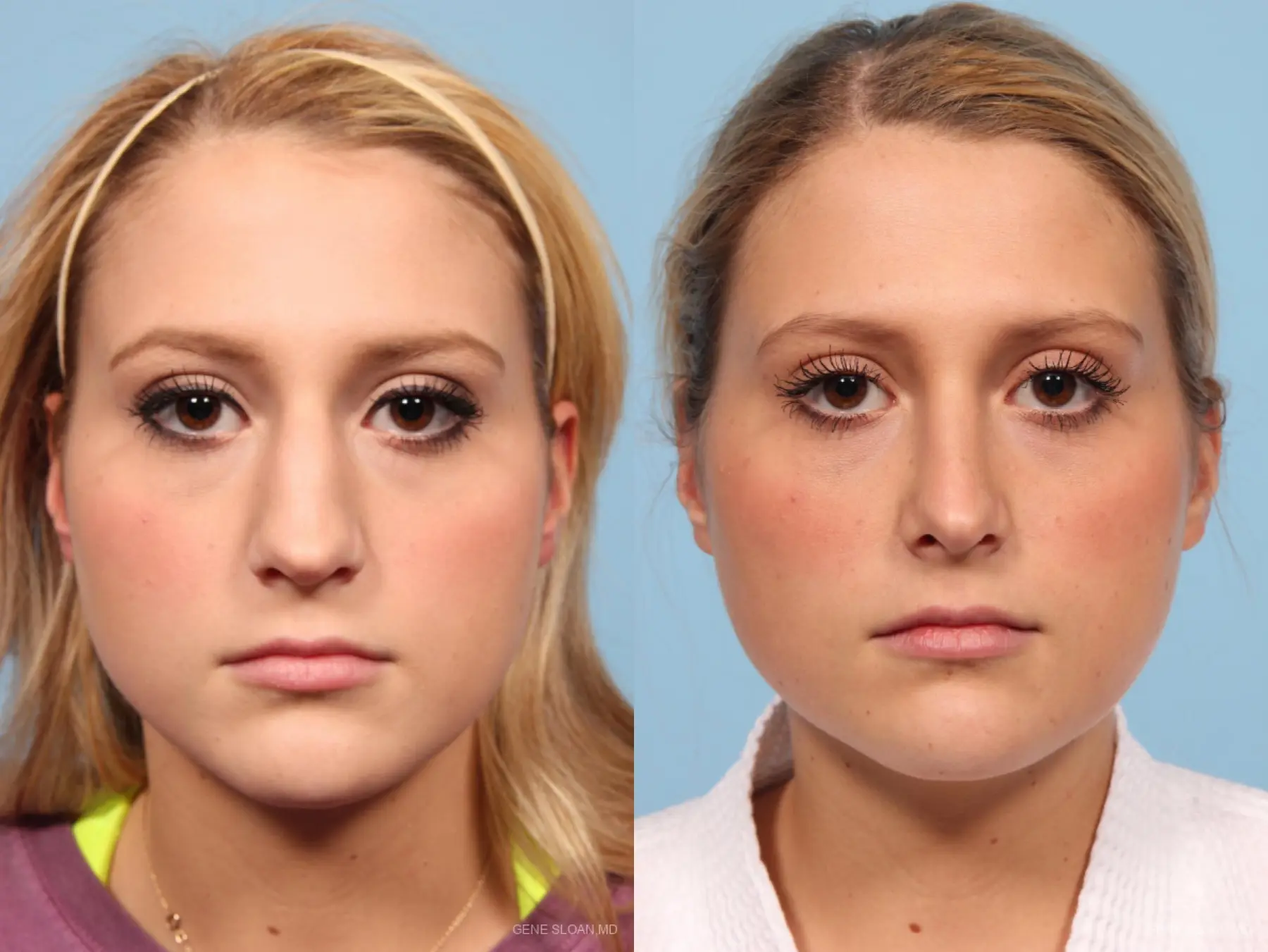 Rhinoplasty: Patient 6 - Before and After 1