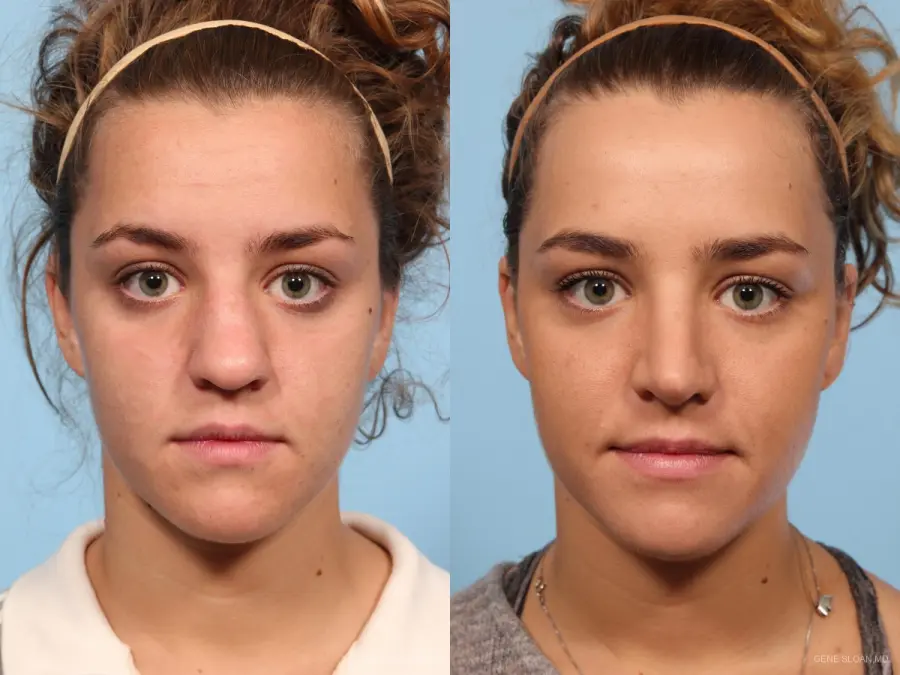 Rhinoplasty: Patient 9 - Before and After  