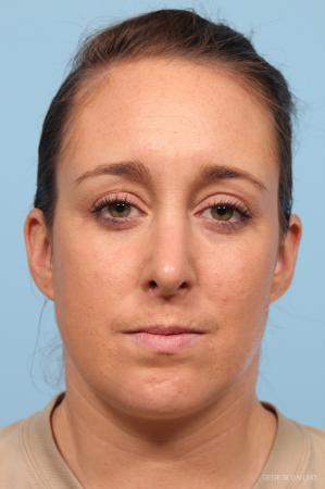 Rhinoplasty: Patient 4 - After Image 1
