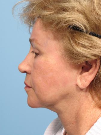 Facelift: Patient 1 - After Image 2