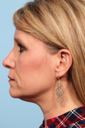 Rhinoplasty: Patient 3 - After Image 2