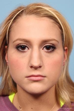 Rhinoplasty: Patient 6 - Before Image 1