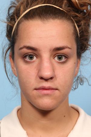 Rhinoplasty: Patient 9 - Before Image 1