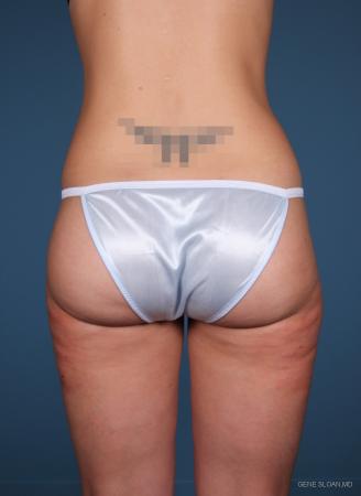 Liposuction: Patient 1 - After Image 2