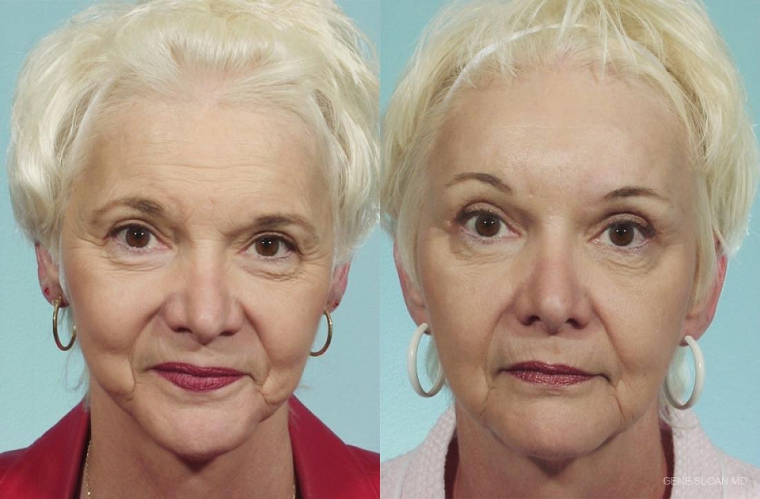 Brow Lift: Patient 2 - Before and After 
