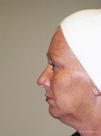 Facelift: Patient 4 - Before and After Image 2