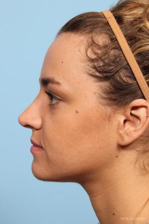Rhinoplasty: Patient 9 - After Image 2