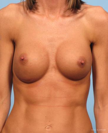 Breast Augmentation: Patient 9 - After Image 1