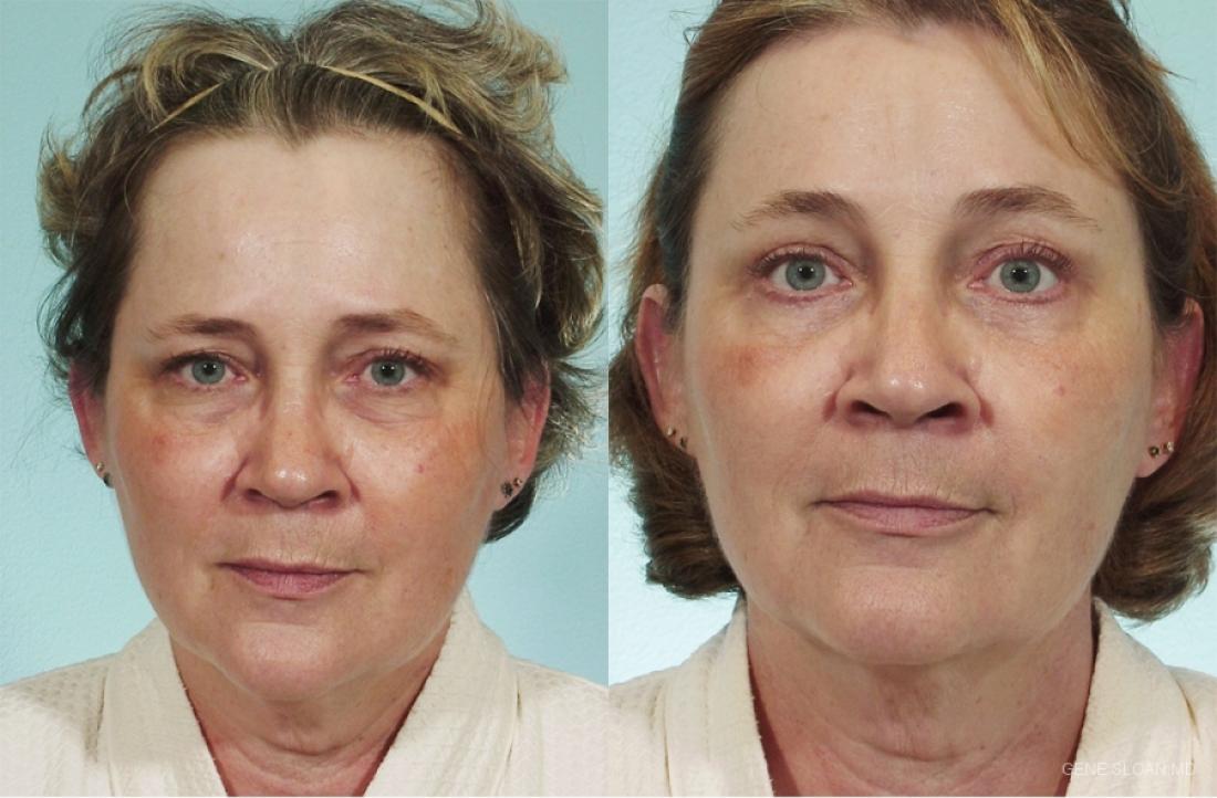 Brow Lift: Patient 1 - Before and After 