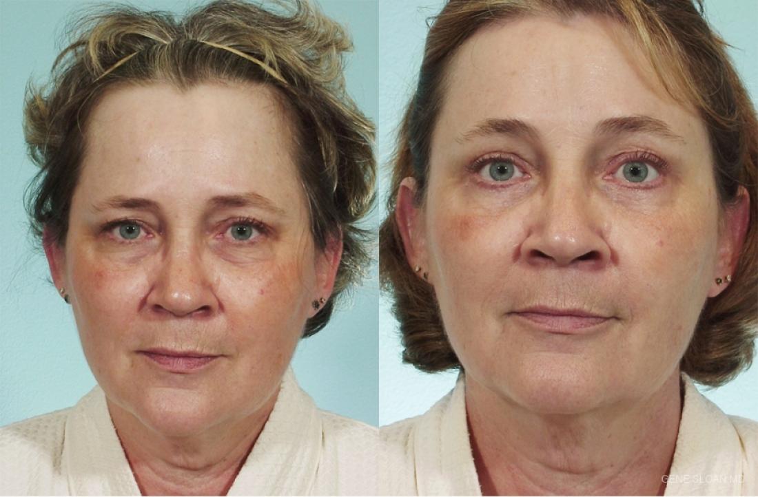 Brow Lift: Patient 1 - Before and After