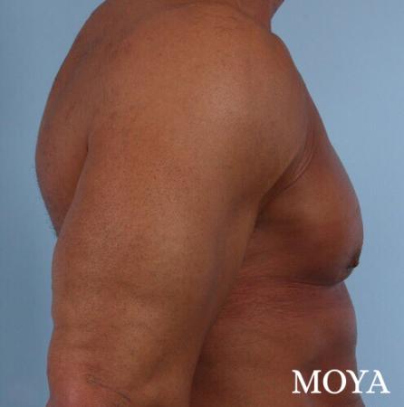 Male Breast Reduction: Patient 5 - After Image 1