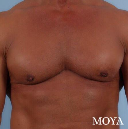 Male Breast Reduction: Patient 5 - After Image 2
