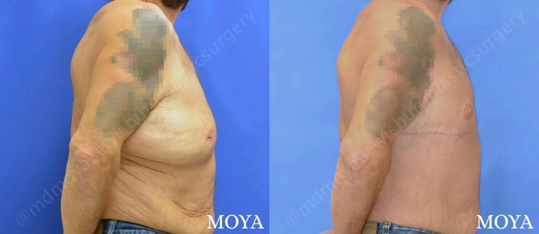 Male Upper Body Lift: Patient 1 - Before and After 3