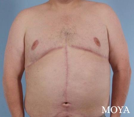 Upper Body Lift: Patient 2 - After Image 2