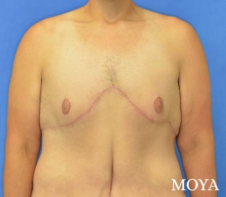 Upper Body Lift: Patient 1 - After Image 2