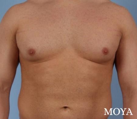 Male Breast Reduction: Patient 4 - Before and After Image 2