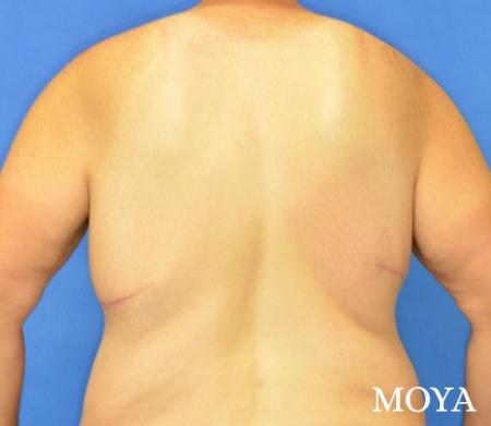 Upper Body Lift: Patient 1 - After Image 3