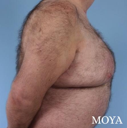 Upper Body Lift: Patient 3 - Before Image 1