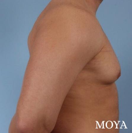 Male Breast Reduction: Patient 4 - Before Image 1
