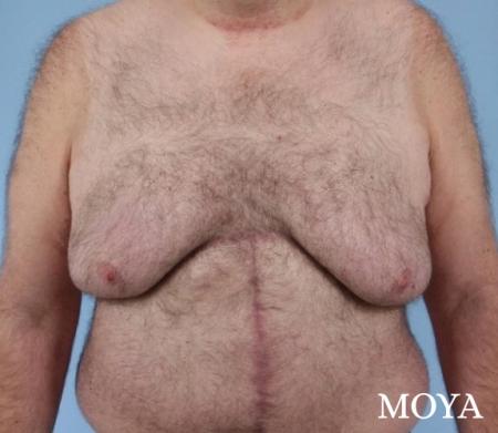 Upper Body Lift: Patient 3 - Before and After Image 2