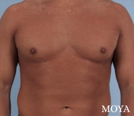 Male Breast Reduction: Patient 4 - After Image 2