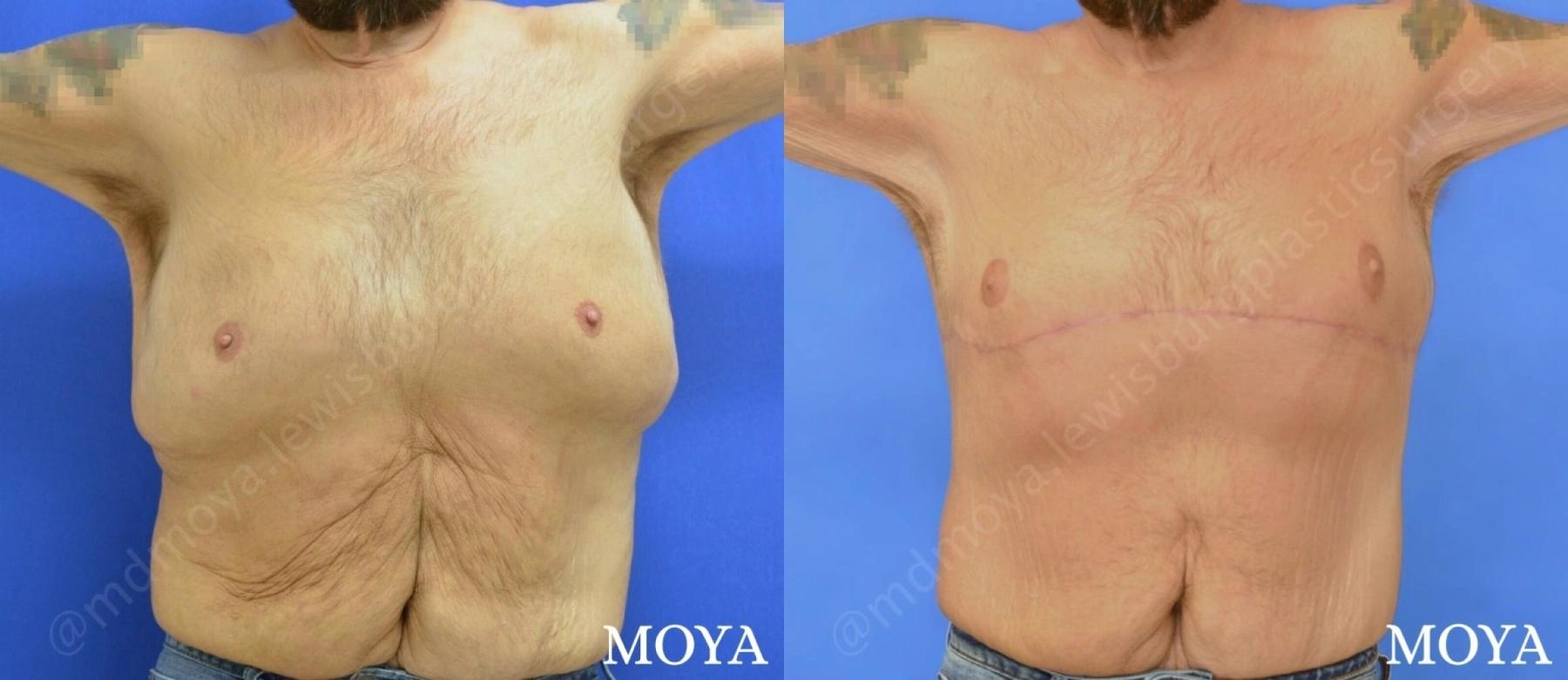 Male Upper Body Lift: Patient 1 - Before and After 2