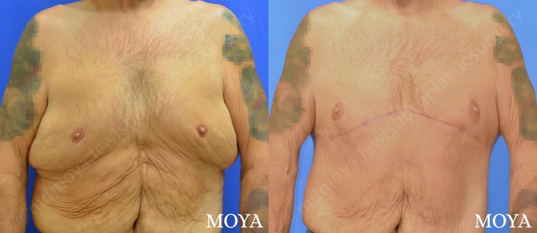 Male Upper Body Lift: Patient 1 - Before and After  