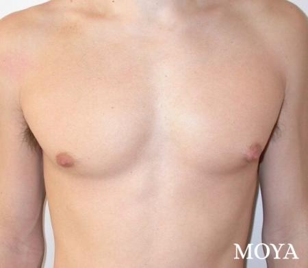 Male Breast Reduction: Patient 3 - Before and After Image 2