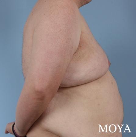 Upper Body Lift: Patient 2 - Before Image 1