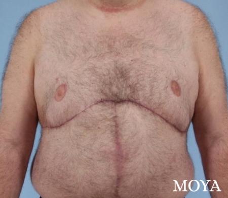 Upper Body Lift: Patient 3 - After Image 2