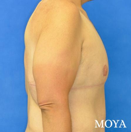 Upper Body Lift: Patient 1 - After Image 1