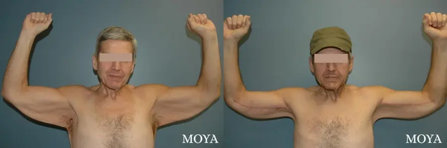 Arm Lift (major: medial incision) - Before and After  