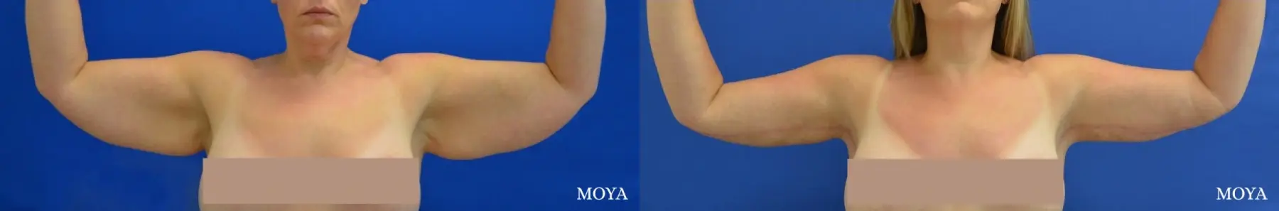 Arm Lift (MAJOR: inseam) - Before and After  