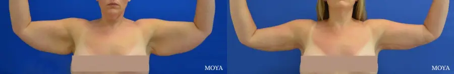Arm Lift (MAJOR: inseam) - Before and After  