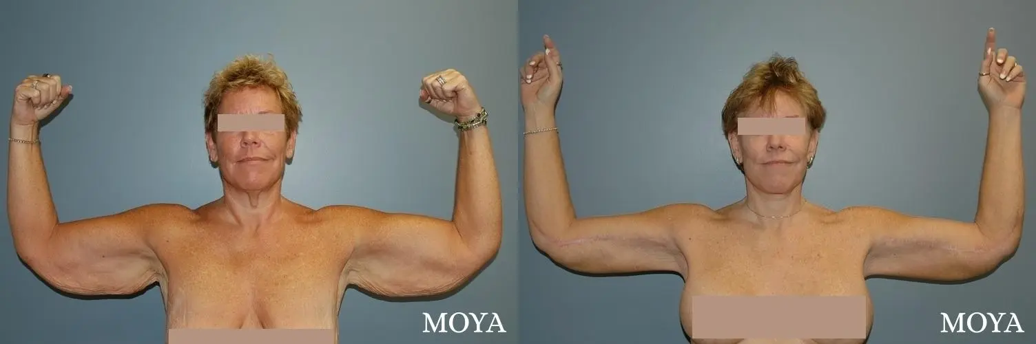 Arm Lift (major: extended medial incision) - Before and After  