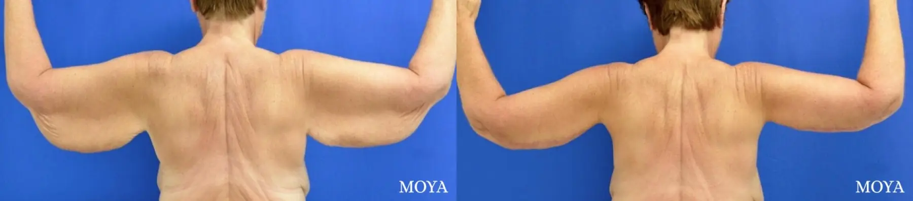 Arm Lift (MAJOR: posterior) - Before and After 2