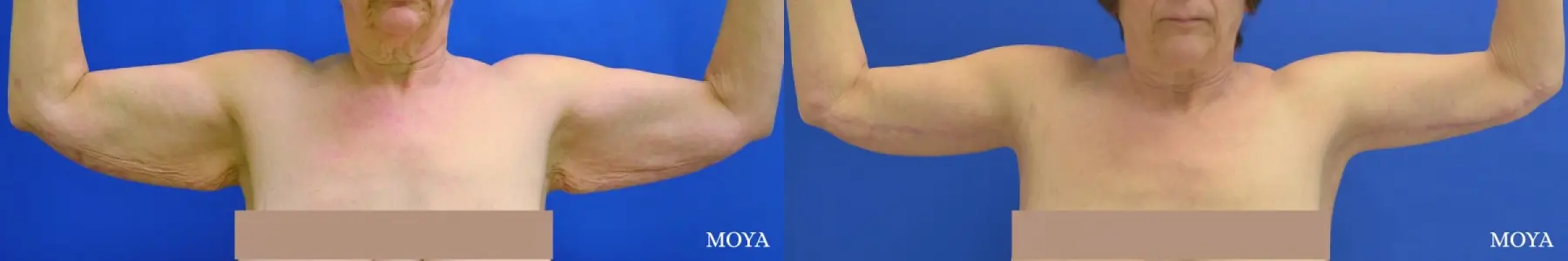 Arm Lift (MAJOR: inseam) - Before and After  