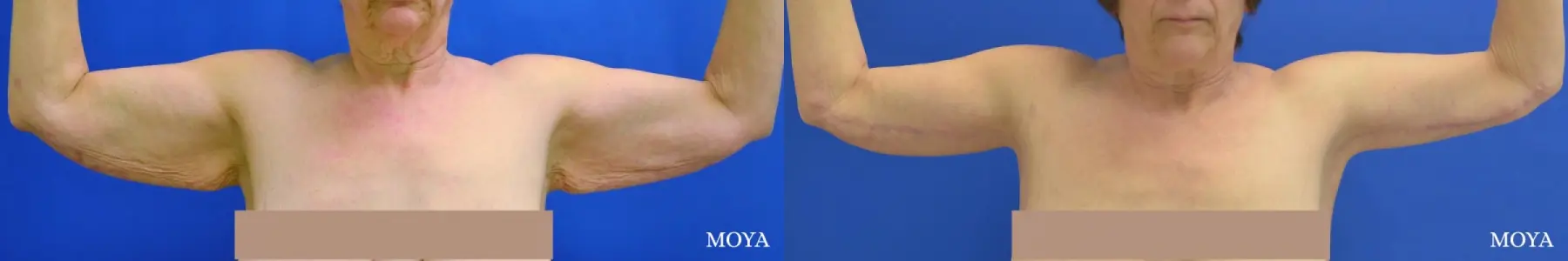 Arm Lift (MAJOR: inseam) - Before and After 1