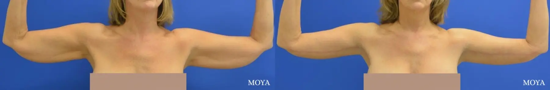 Arm Lift (MAJOR: inseam) - Before and After 1