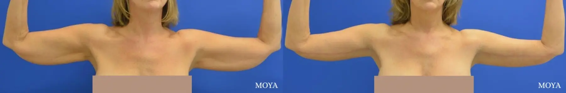 Arm Lift (MAJOR: inseam) - Before and After  