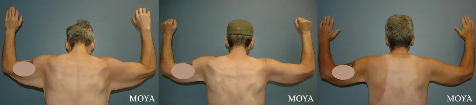 Arm Lift (major: medial incision) - Before and After 2