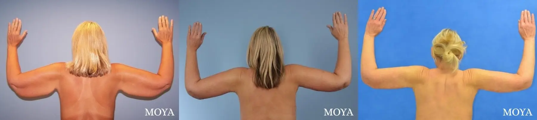 Arm Lift (major: posterior incision) - Before and After 2