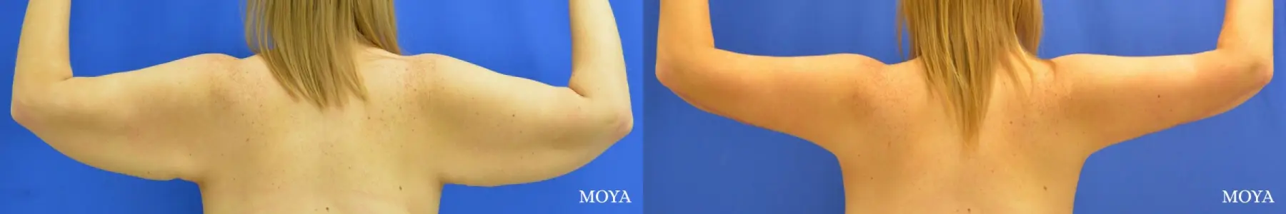 Arm Lift (MAJOR: posterior) - Before and After 2