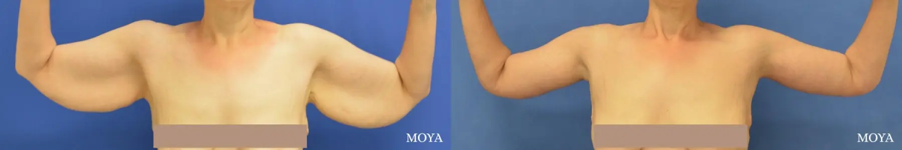 Arm Lift (MAJOR: posterior) - Before and After  