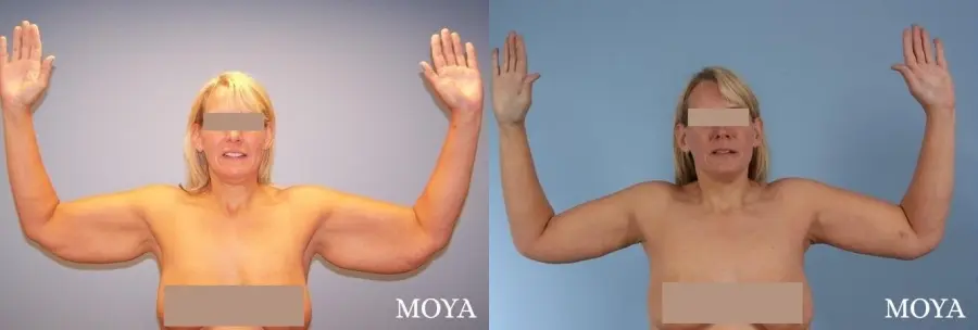 Arm Lift (major: posterior incision) - Before and After  