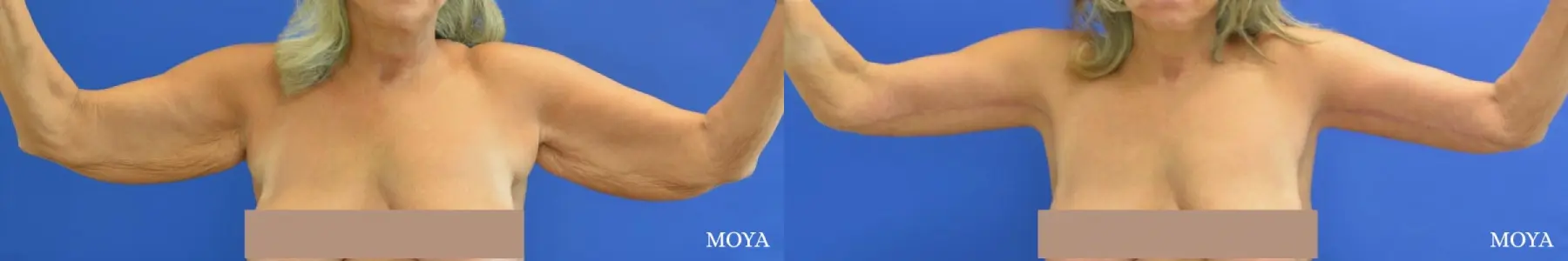 Arm Lift (MAJOR: inseam) - Before and After 1