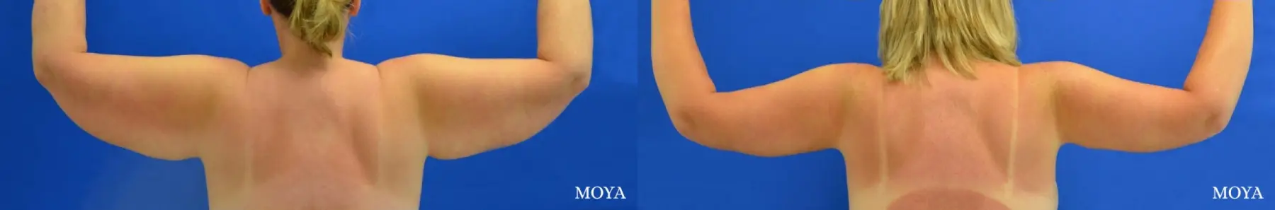 Arm Lift (MAJOR: inseam) - Before and After 2