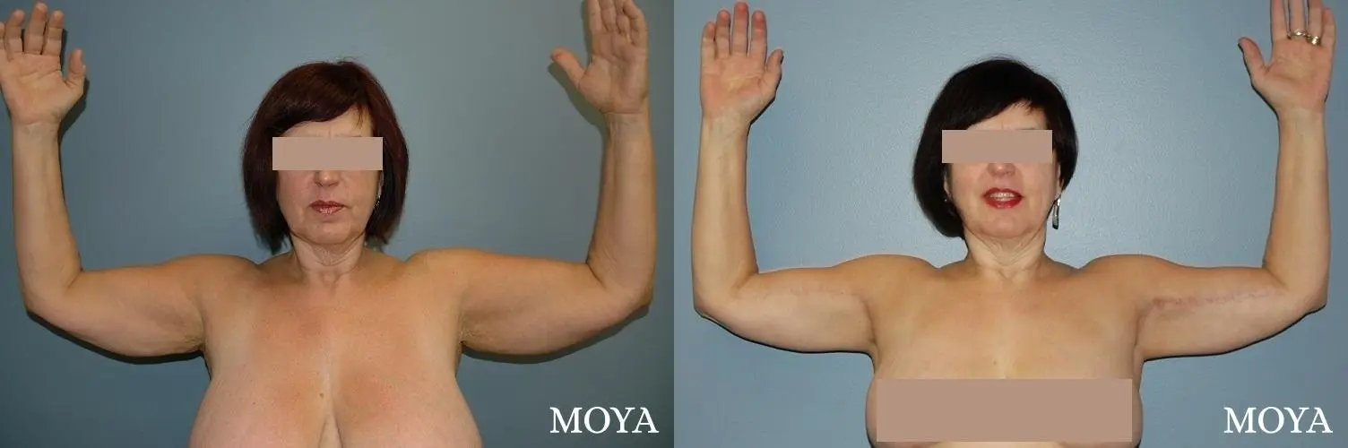 Arm Lift (standard: medial incision) - Before and After 1